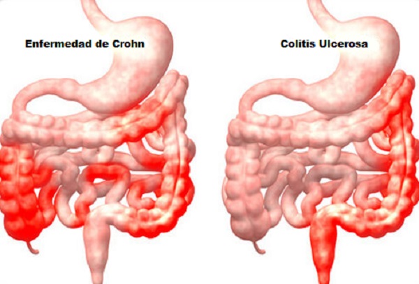 enfermedad de Crohn te está haciendo engordar