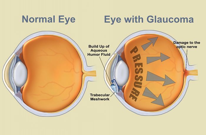gráfico que muestra la presencia de glaucoma