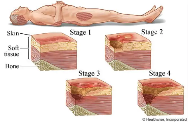etapas de úlceras por presión