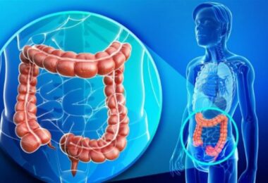 Fructosa relacionada con el cáncer de colon