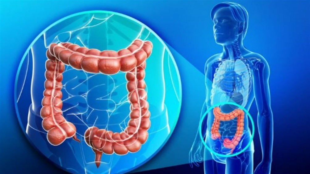 Fructosa relacionada con el cáncer de colon