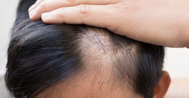 Hombre que sufre la caída del cabello