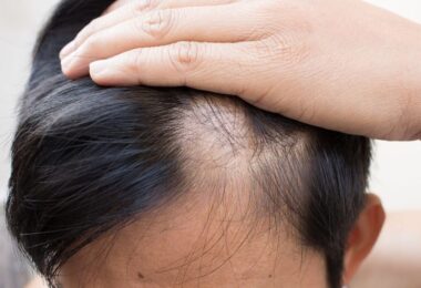Hombre que sufre la caída del cabello