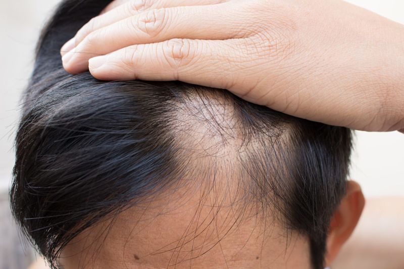 Hombre que sufre la caída del cabello