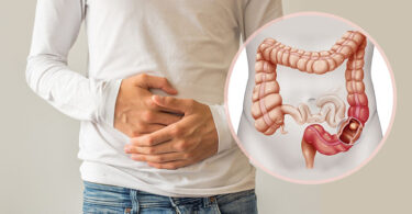 Cáncer de colon