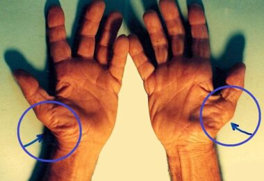 El síndrome del túnel carpiano relacionado con la diabetes