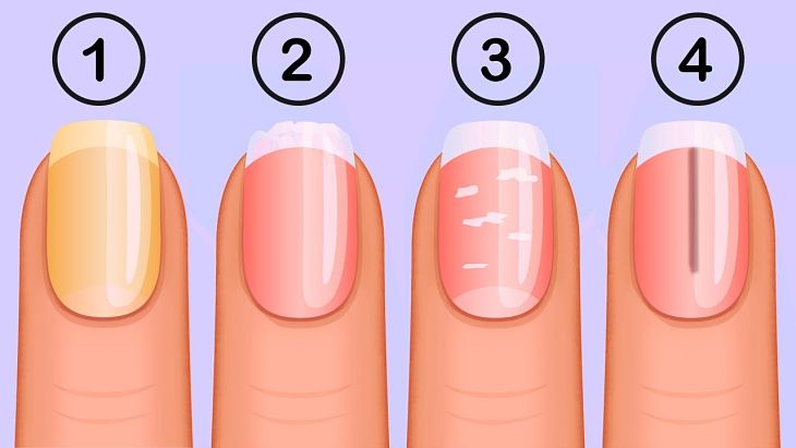 4. Nail Changes During Pregnancy: What's Normal and What's Not - wide 9