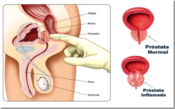 próstata agrandada síntomas