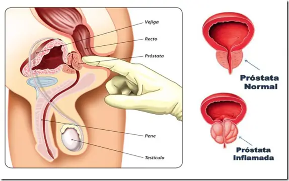 próstata agrandada