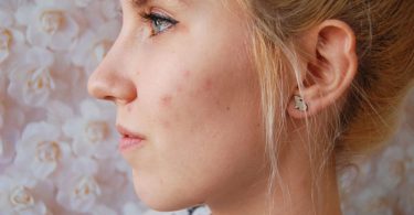 Mujer con acné en el rostro
