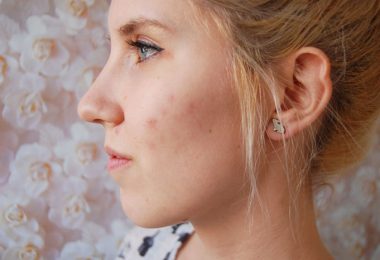 Mujer con acné en el rostro