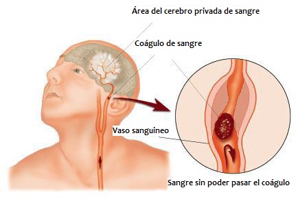 derrame cerebral