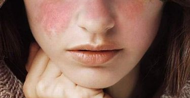 las señales del lupus en el rostro de una mujer