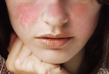 las señales del lupus en el rostro de una mujer