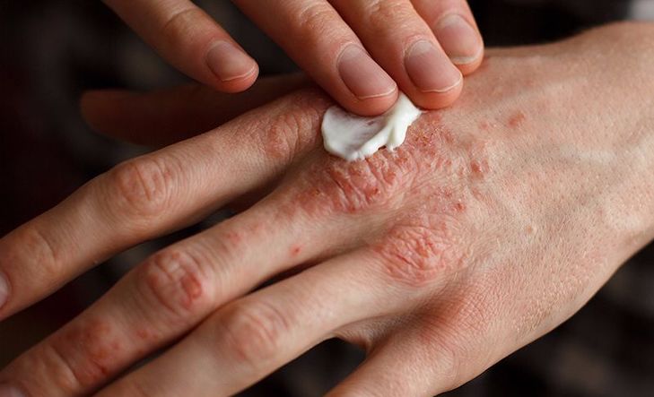 eccema y psoriasis crema