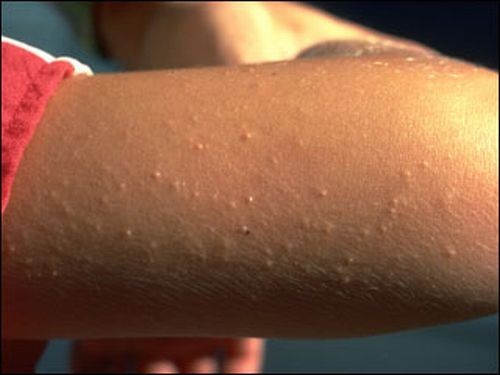 sin gluten queratosis