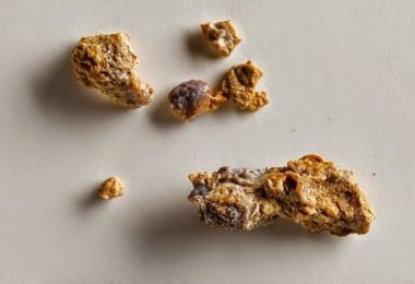 piedras en los riñones