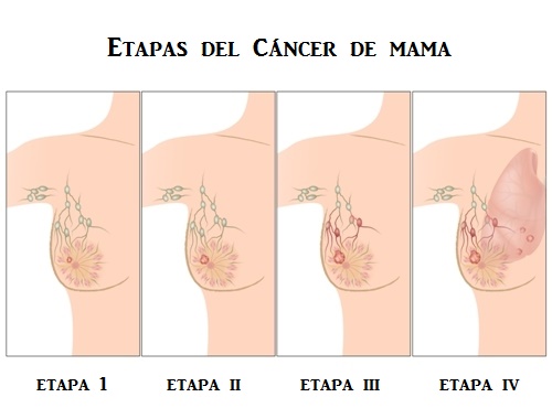  cáncer de mama Gráfico