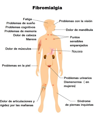 fibromialgia gráfico