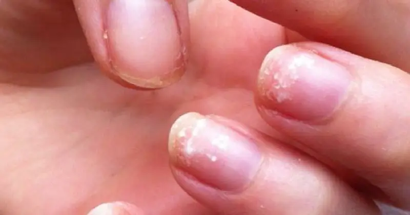 Rebajar Majestuoso Beca 8 Advertencias de salud que tus uñas pueden estarte enviando