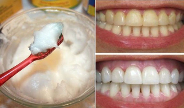 bicarbonato de sodio para los dientes