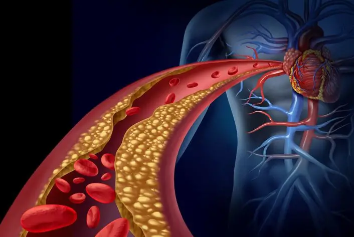 limpiar arterias obstruidas