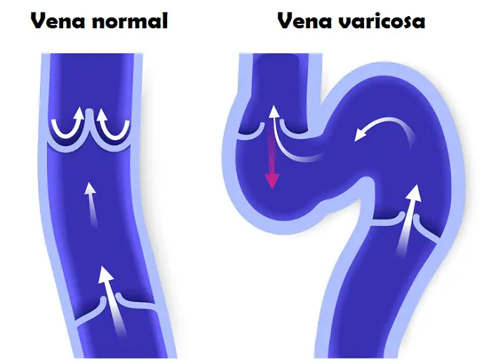 tratar las varices Venas varicosas varices