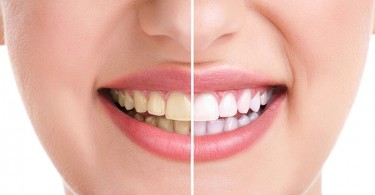 Imagen que muestra cómo se ven los dientes amarillentos