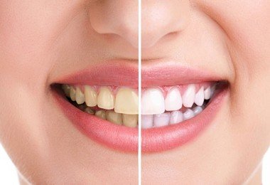 Imagen que muestra cómo se ven los dientes amarillentos