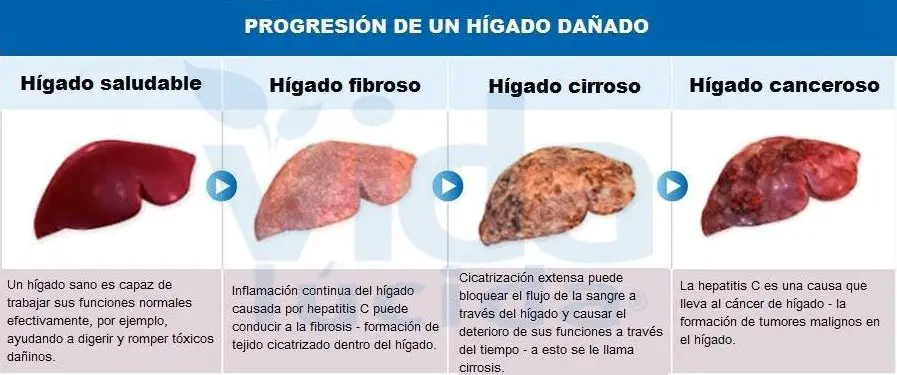 hígado dañado progresión