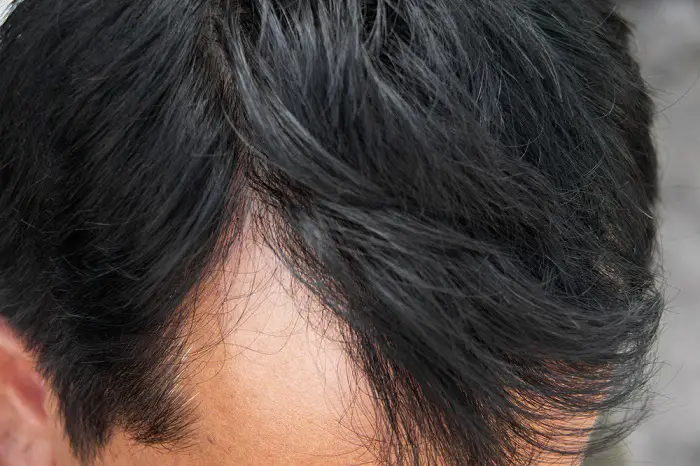 alopecia areata