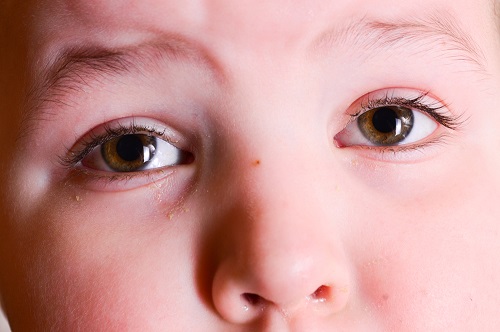 conjuntivitis viral en niños