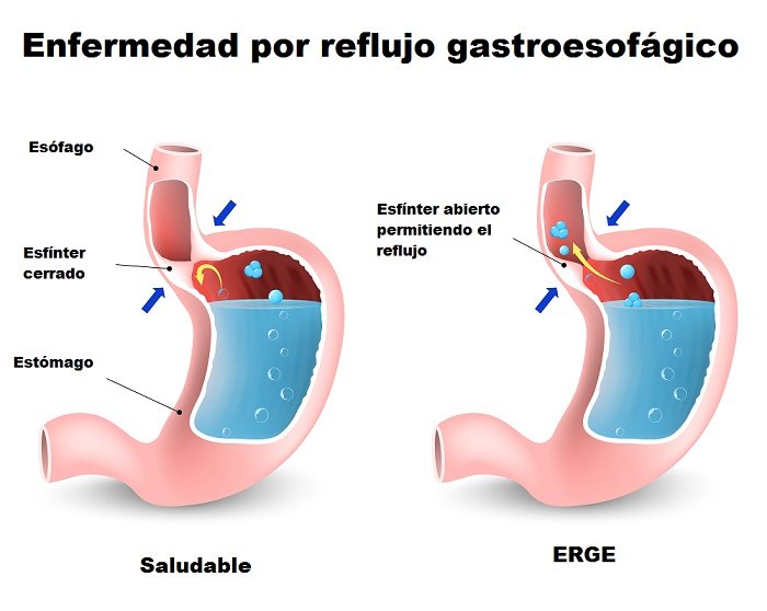 reflujo ácido acidez estomacal 