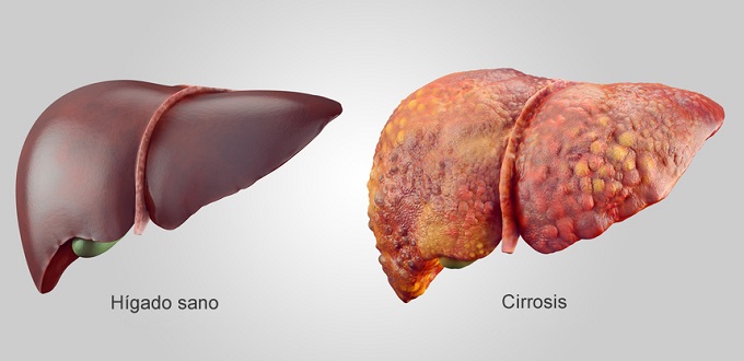 cirrosis hepática