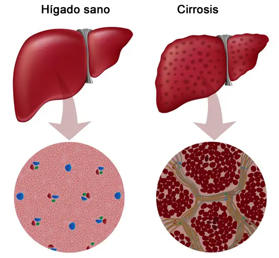 gráfico descriptivo sobre la cirrosis