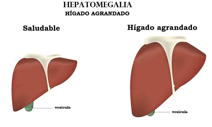 Hígado agrandado