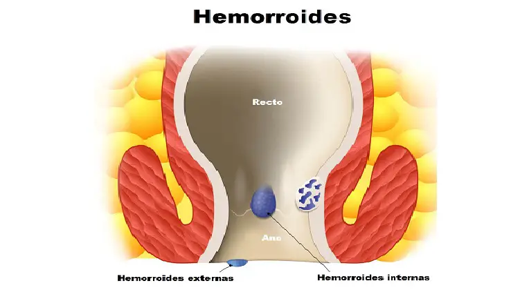 hemorroides