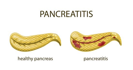 pancreatitis