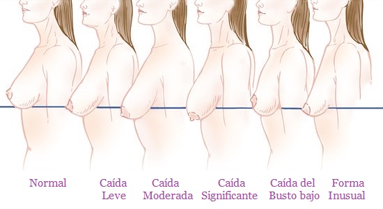 tipos de busto caído