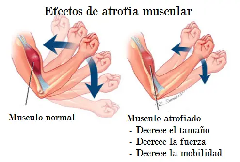 efectos de la atrofia muscular