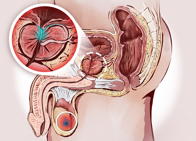 cáncer de próstata