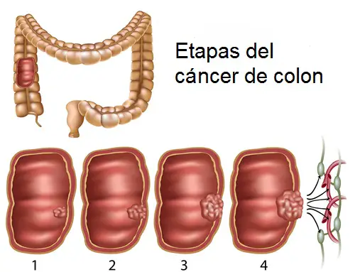 etapas del cáncer de colon