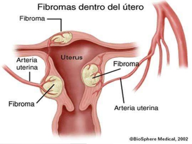 miomas uterinos