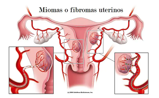 Miomas fibromas uterinos