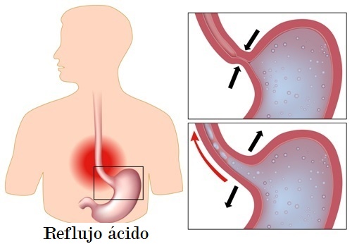 reflujo ácido