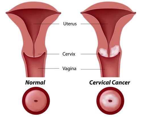 cáncer cervical