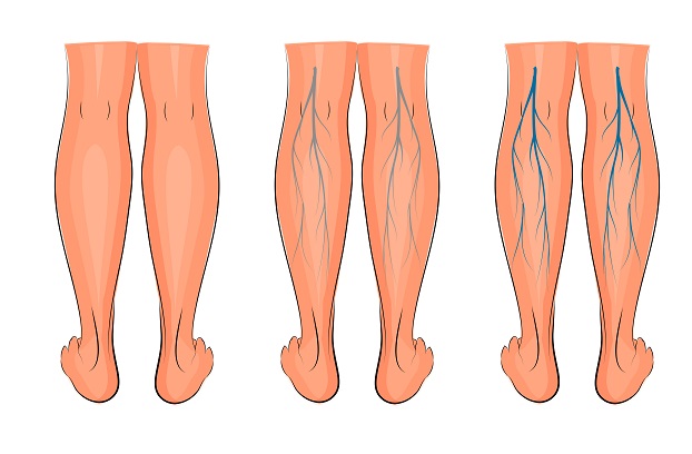 causas de la flebitis