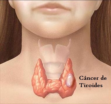 cáncer tiroides