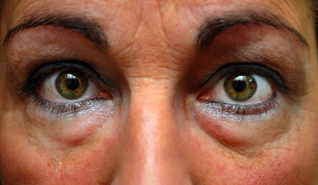 La hinchazón debajo de los ojos puede acabarse