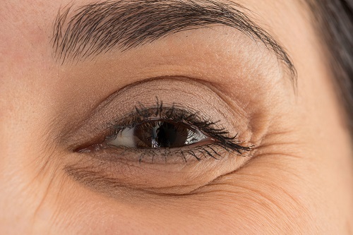 Ojos hinchados y como tratarlos